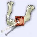 Fogbeültetés, fogászati implantátum