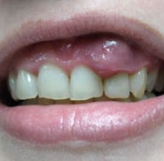 fogak kezelésére gyermekeknél cukorbetegség)